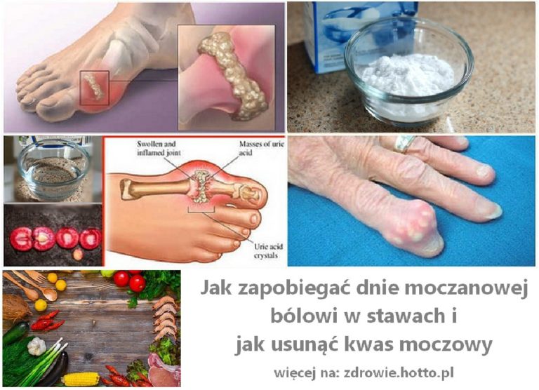 Jak zapobiegać dnie moczanowej, usunąć kwas