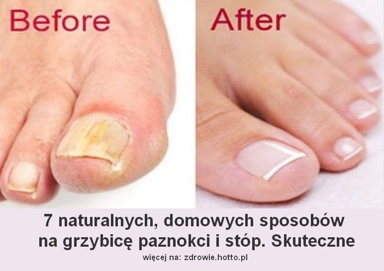 zdrowie.hotto.pl-jak wyleczyć grzybicę stóp i paznokci - domowe sposoby, przepisy