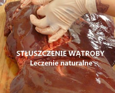 zdrowie.hotto.pl-stuszczenie-watroby-leczenie-naturalne