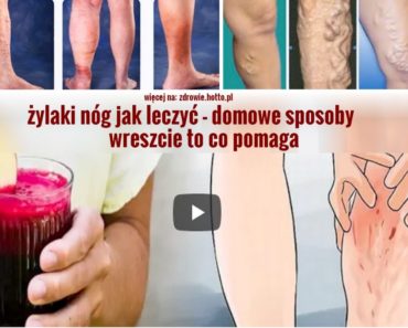 zdrowie.hotto.pl-zylaki-nog-jak-leczyc-domowe-sposoby