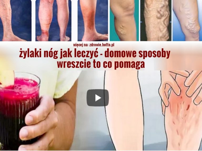 Ylaki Na Nogach Jak Leczy Domowe Sposoby I Przepisy Spos B Extra