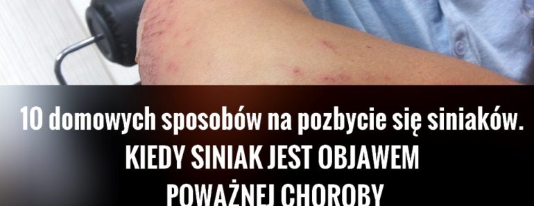zdrowie.hotto_.pl-siniaki-jak-sie-pozbyc-przepisy-objawy-choroby.jpg